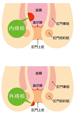 いぼ痔(痔核)