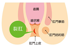 切れ痔(裂肛)