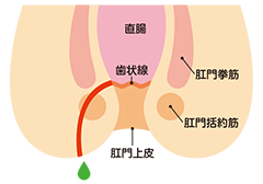 痔ろう(穴痔)