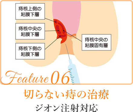 切らない痔の治療ジオン注射対応