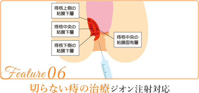 切らない痔の治療ジオン注射対応