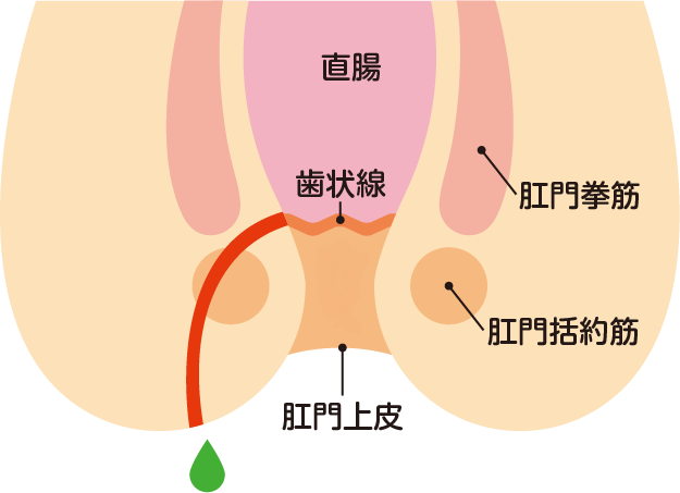 あな痔（痔ろう）