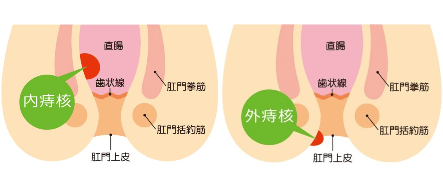 いぼ痔（痔核）