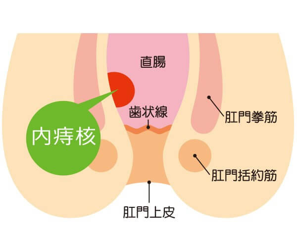 いぼ痔「内痔核」