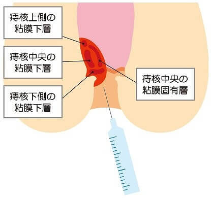 ジオン注射